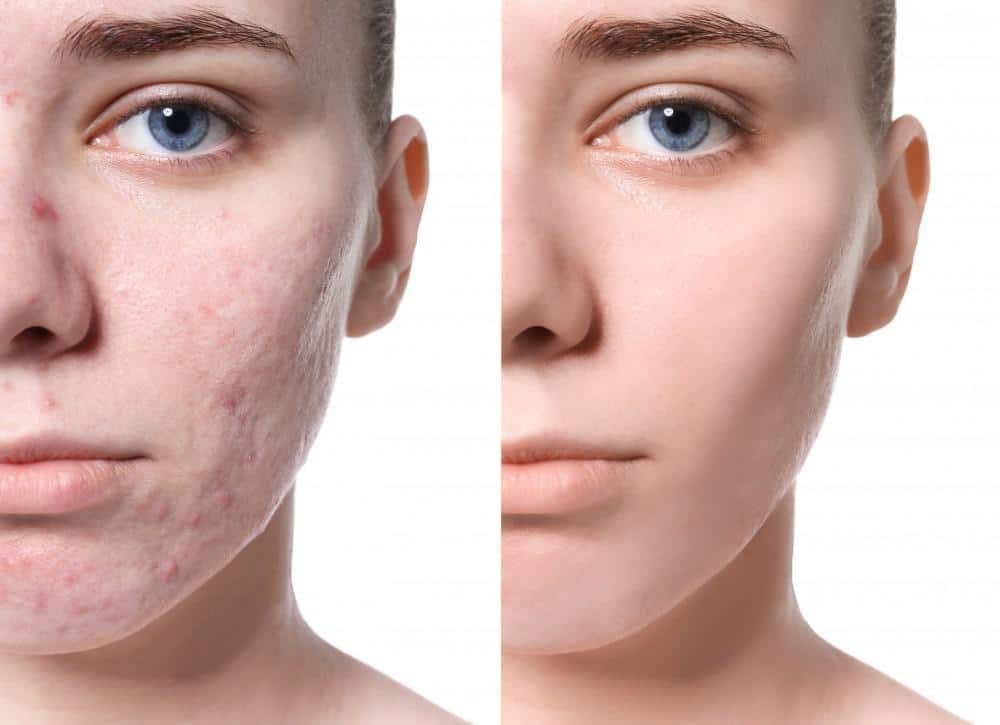 Top Ways to Prevent and Treat Acne Scars